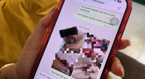 Por negligencia en cirugía estética, perdió el seno
